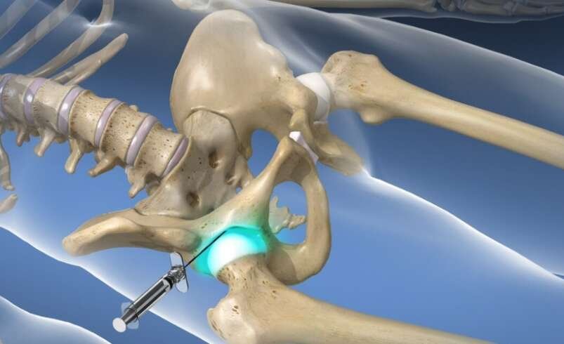 Hip Pain at Night Causes, Relief, and When to Seek Care