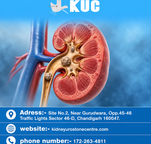 Kidney Stone Disease: What Every Person Needs to Know About Causes, Symptoms, and Prevention