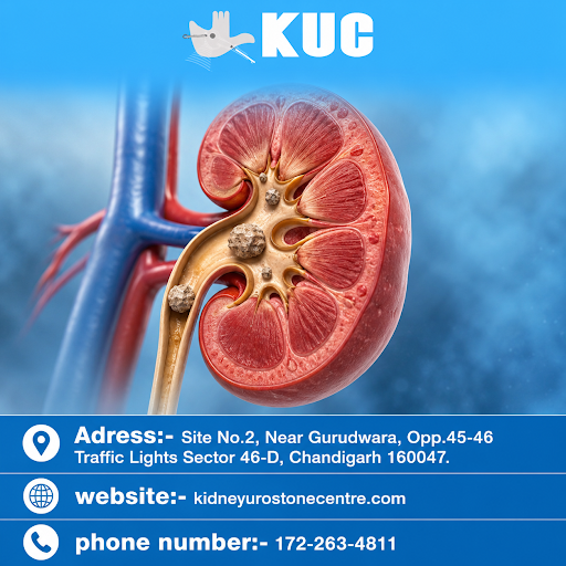 Kidney Stone Disease: What Every Person Needs to Know About Causes, Symptoms, and Prevention