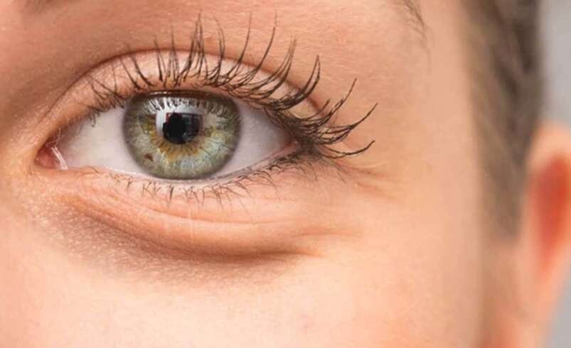 Lower Blepharoplasty in London: How Does Surgery Improve Under-Eye Bags?