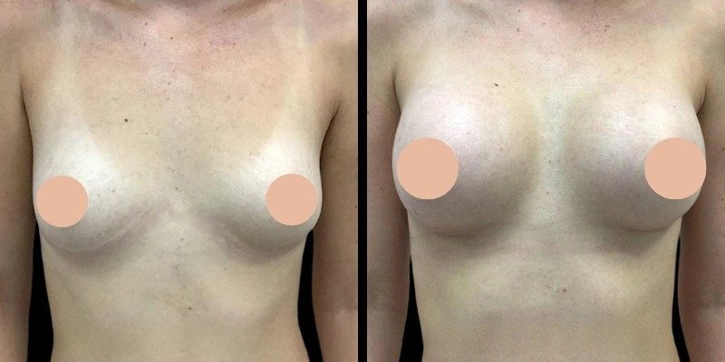 Best Breast Augmentation Surgeon in Dubai: Preparing for Your Breast Enhancement Journey
