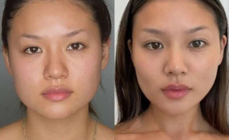Buccal Fat Removal Modern Beauty Best Doctors in Dubai