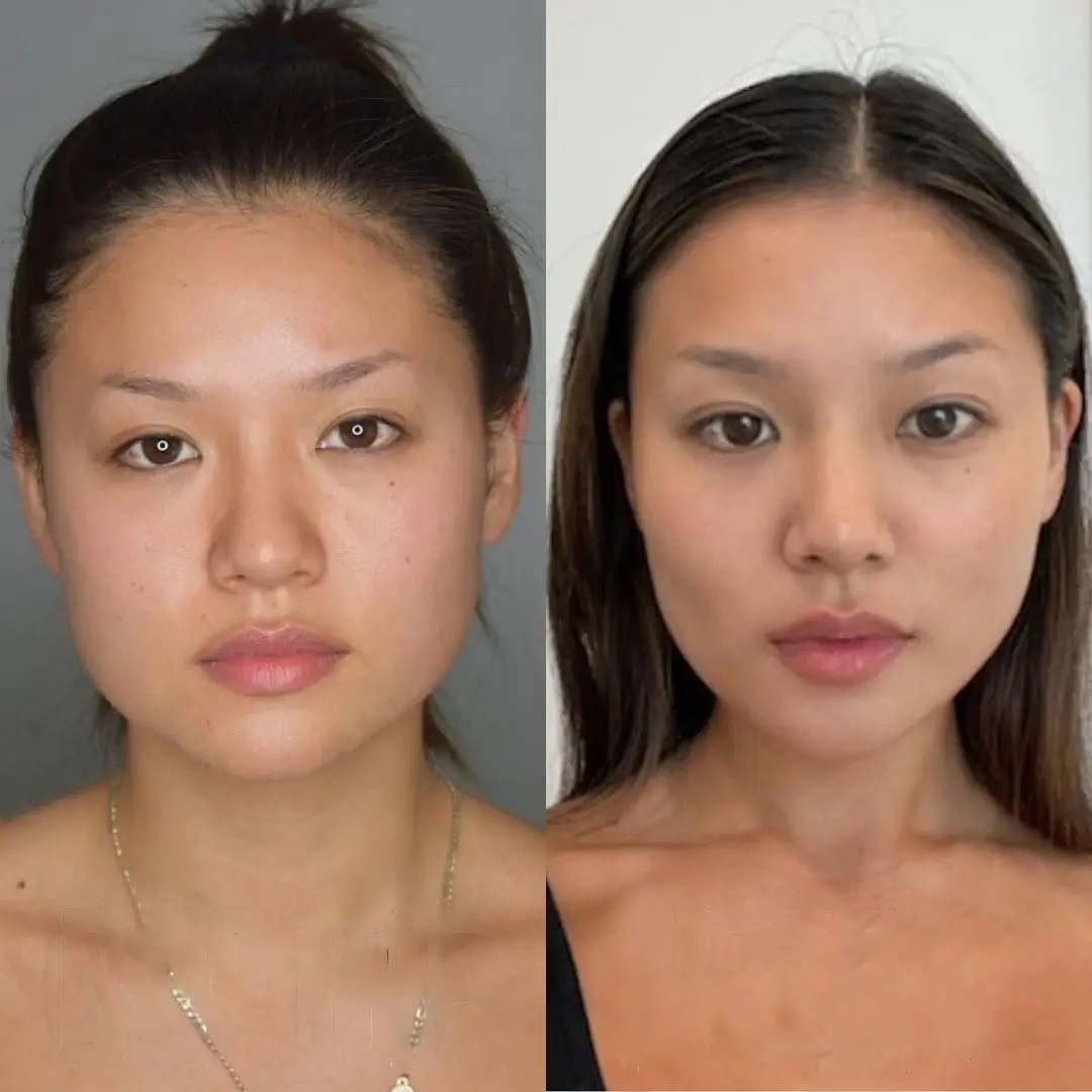 Buccal Fat Removal Modern Beauty Best Doctors in Dubai