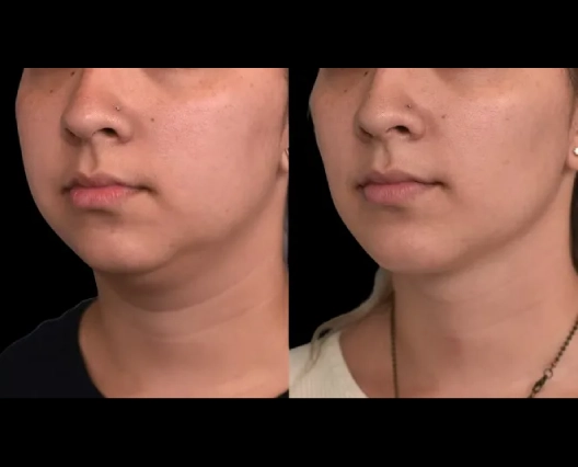 Double chin removal confidence with Best Doctors in Dubai