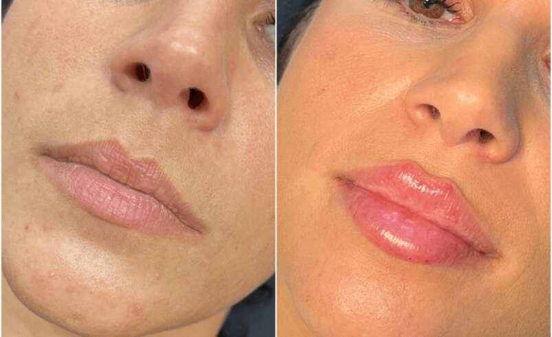 Juvederm Facial Harmony Best Doctors in Dubai