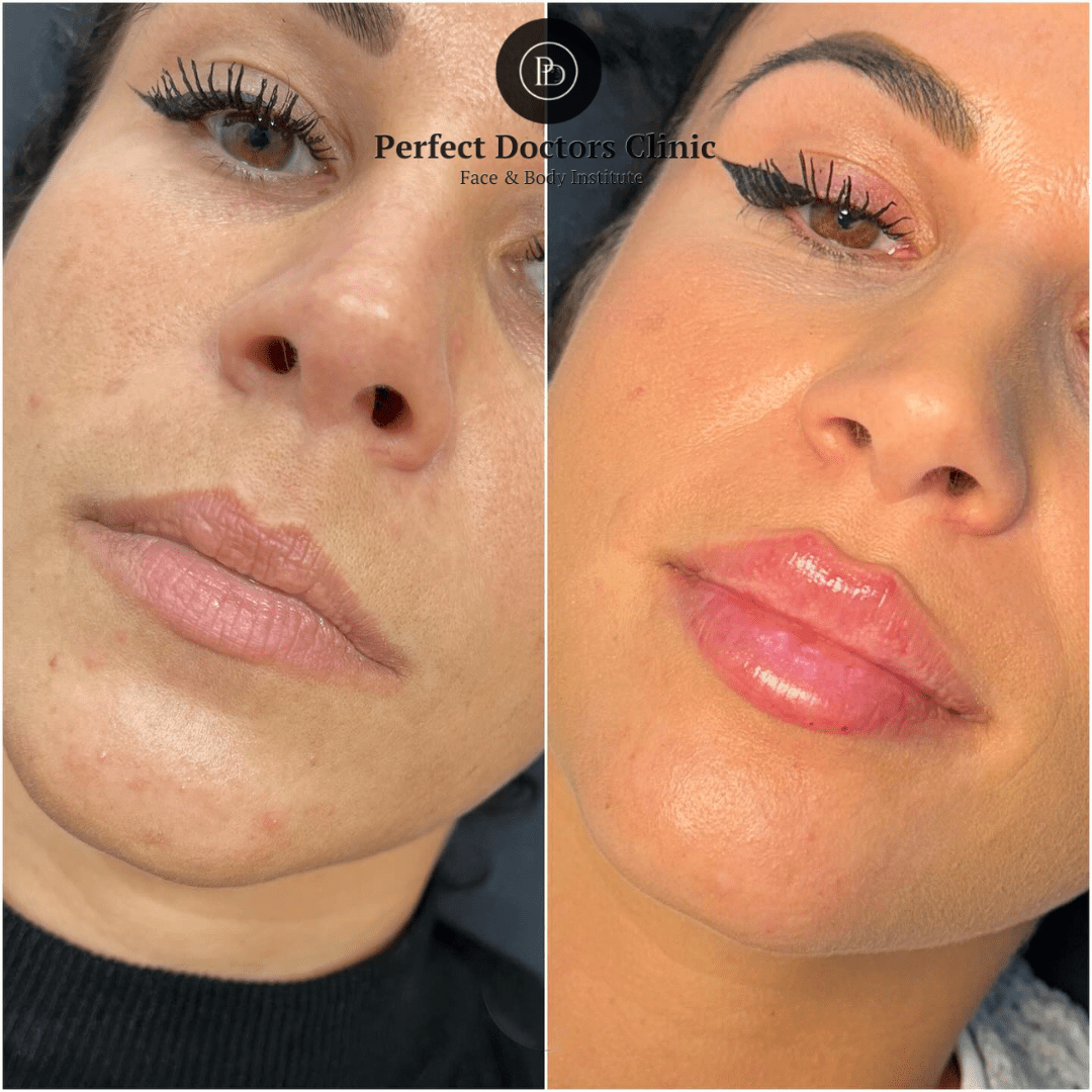 Juvederm Facial Harmony Best Doctors in Dubai