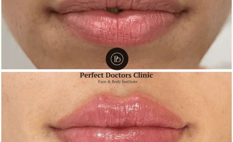 Juvederm Volume Loss Best Aesthetic Clinic in Dubai