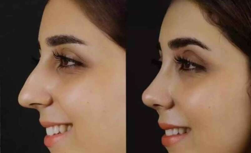 How Do Doctors Perform Nose Deviated Septum Surgery in Dubai?