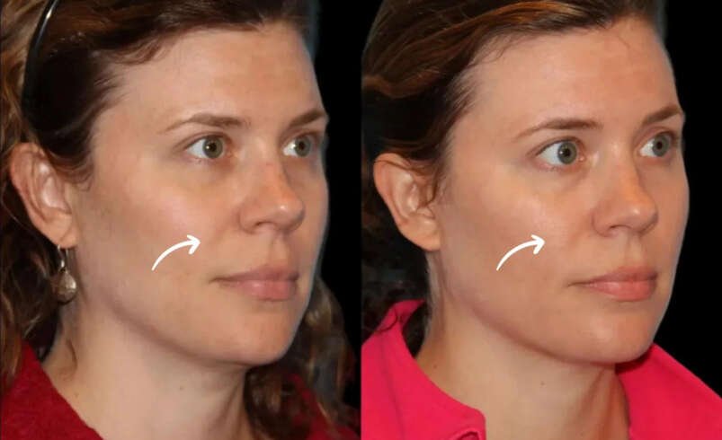 Best Aesthetic Clinic in Dubai Plans Sculptra Fillers for Uneven Texture