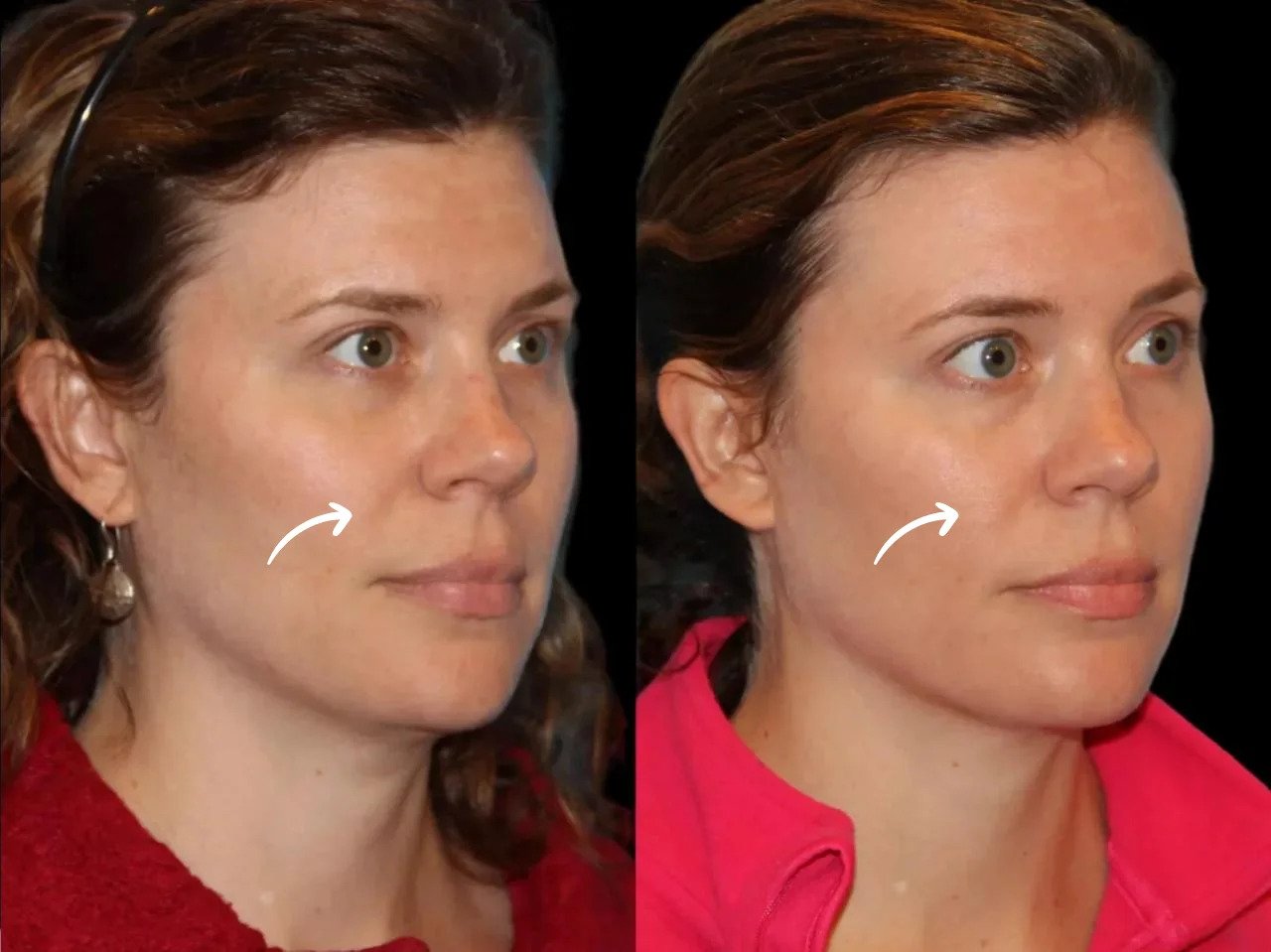 Best Aesthetic Clinic in Dubai Plans Sculptra Fillers for Uneven Texture