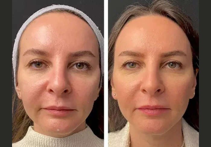 Mesotherapy in Dubai: Mesotherapy for Skin Hydration and Glow