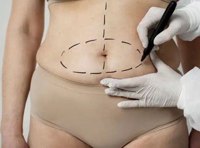 How to Prepare for Your Tummy Tuck in Dubai Consultation