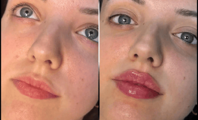 Fillers in Dubai: A Safe Choice for Enhancements