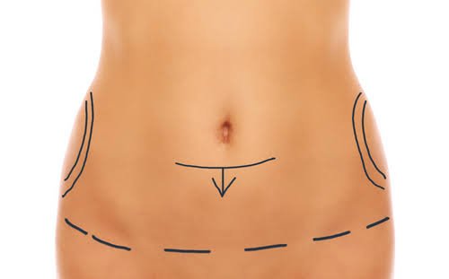Abdominoplastie à Paris : Retrouvez un Ventre Plus Ferme et Harmonieux