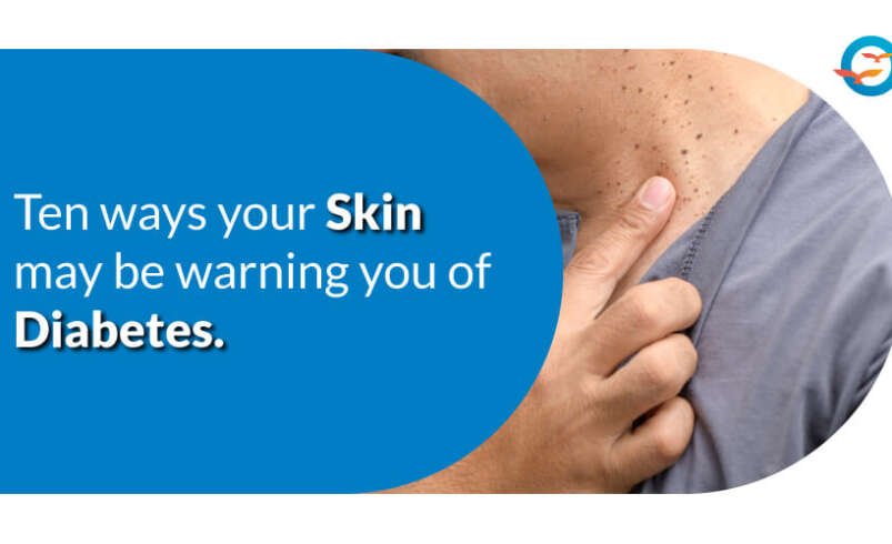 10 Ways Your Skin May Be Warning You of Diabetes