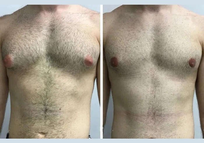 Managing Chest Skin Thickness With Gynecomastia Surgery in dubai