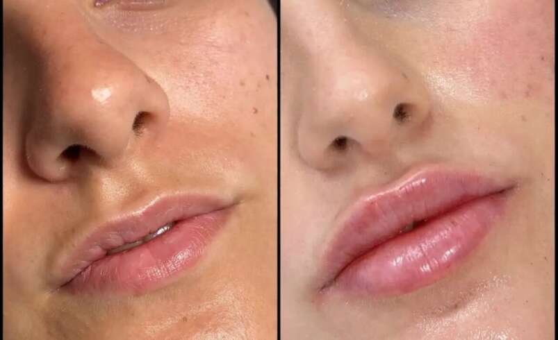 Best Doctors in Dubai for Fillers and Youthful Facial Rejuvenation