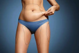 Liposuccion à Paris : Redessinez vos courbes pour une silhouette affinée