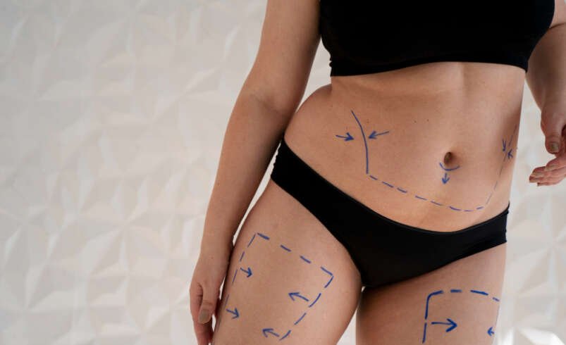 Liposuction in Dubai: Risks and Complications Explained