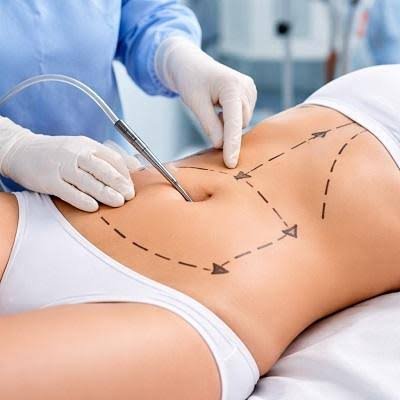 Liposuction Surgery in Dubai: Refined Body Contouring