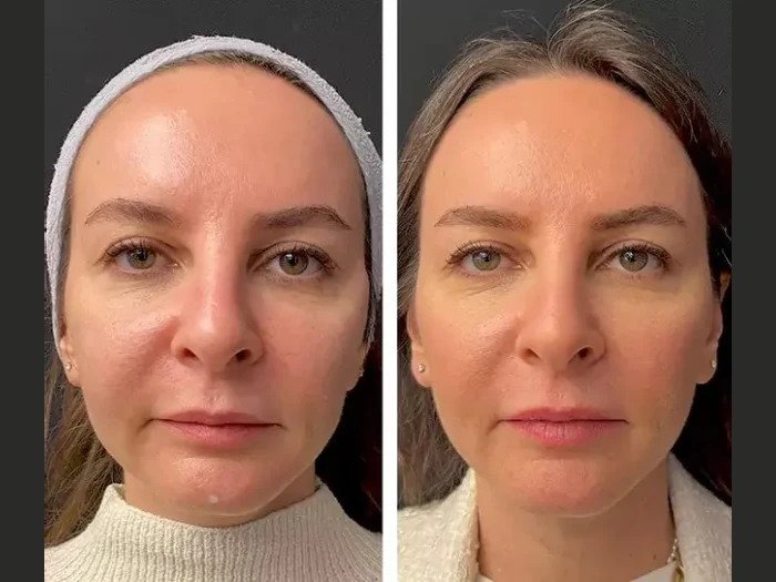 Best Aesthetic Clinics in Dubai for Mesotherapy: Mesotherapy for Acne Scars