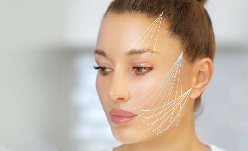 Facial Thread Lift in Dubai for Cheek Lifting
