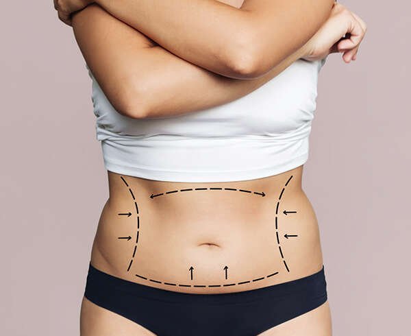 Liposuction Dubai: How Can Body Shape Influence Liposuction Planning?