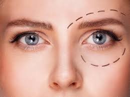 Chirurgie des paupières supérieures à Paris : Un regard ouvert