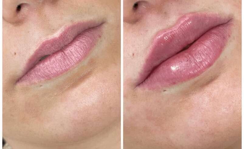 Juvederm in Dubai Facial Aesthetics Guide