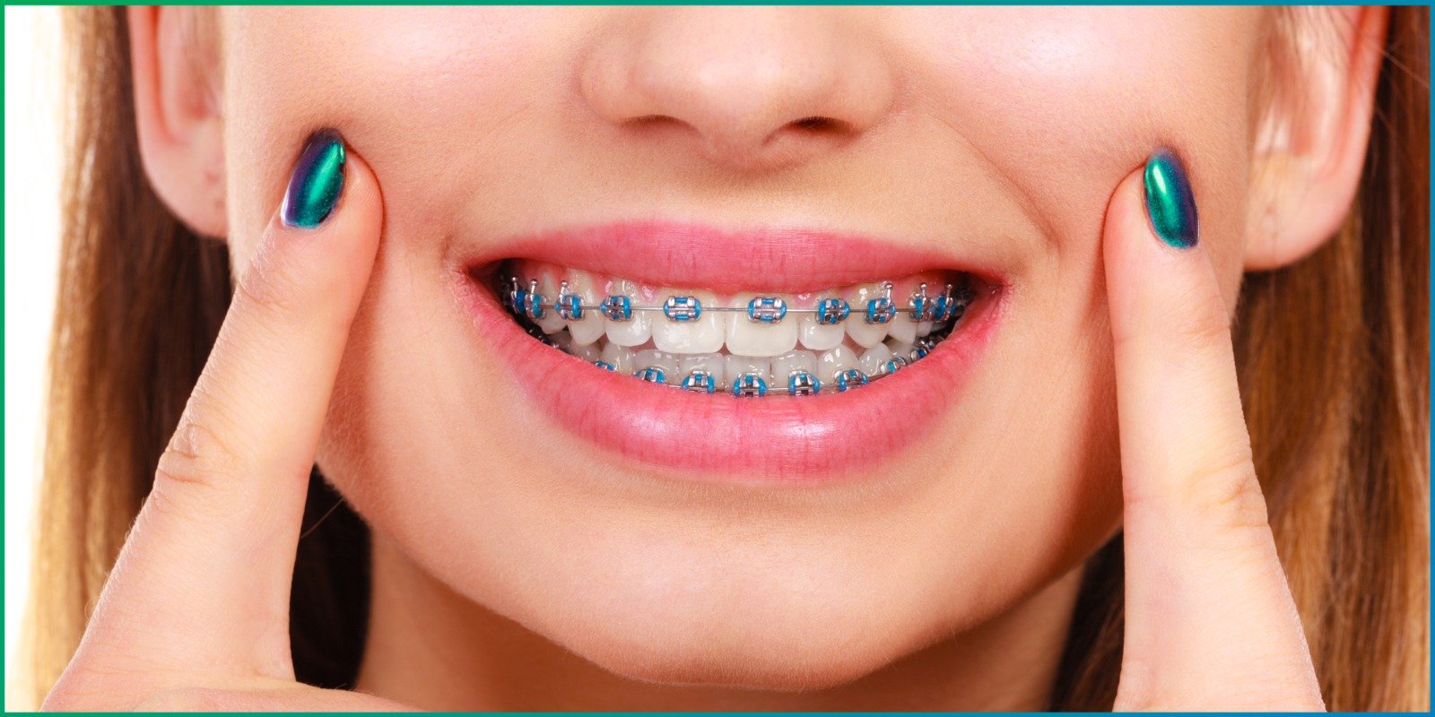 Dental Braces in Pune: Find the Right Braces for Your Teeth