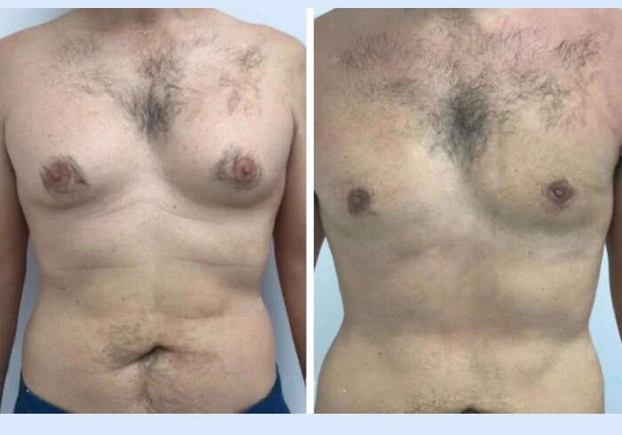 Best Doctors in Dubai for Gynecomastia: A Guide to Better Chest Shape