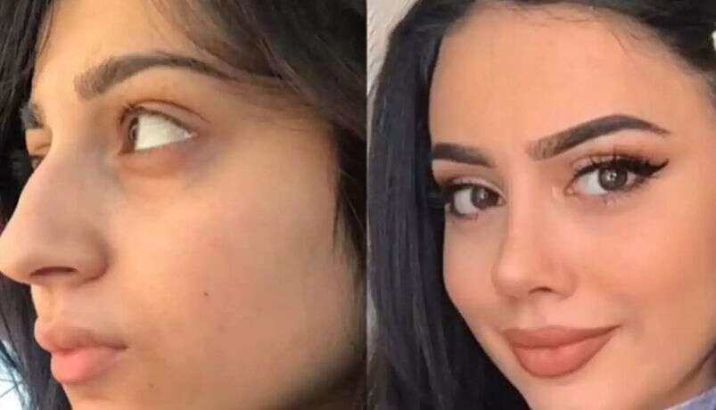 How Do Best Doctors in Dubai Evaluate Rhinoplasty Facial Proportions?