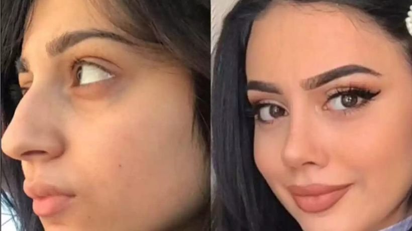 How Do Best Doctors in Dubai Evaluate Rhinoplasty Facial Proportions?