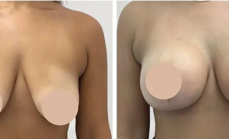 Breast Reduction in Dubai: Advanced Breast Reshaping for Improved Body Proportion