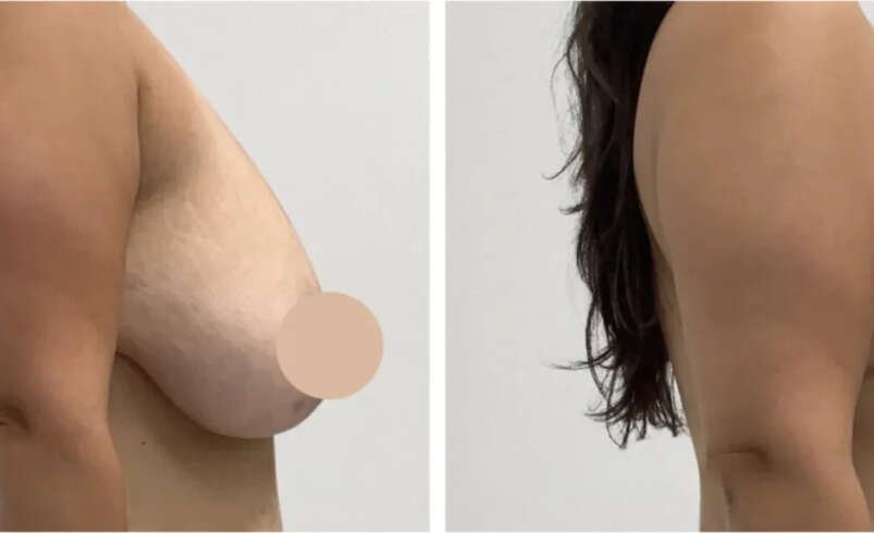 Breast Lift in Dubai for Customized Breast Contouring